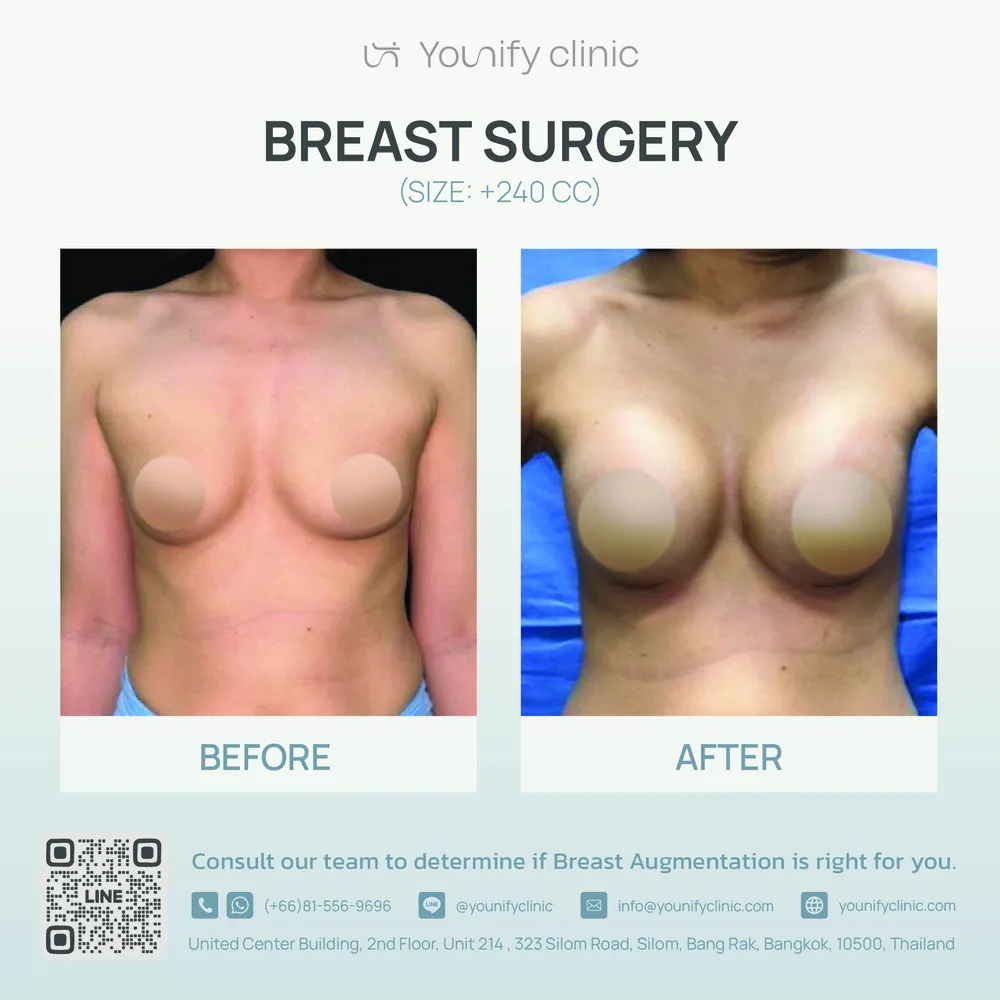 Breast augmentation before & after result — YOUNIFY Clinic