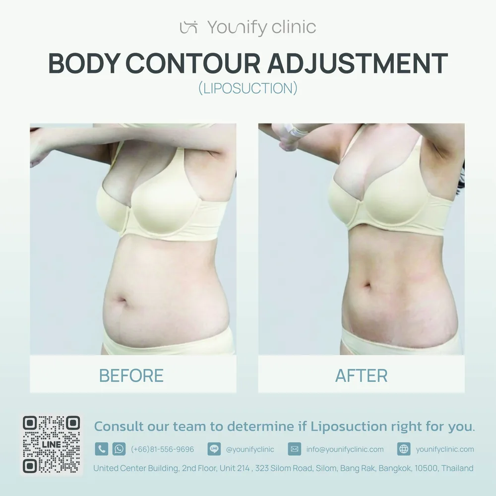 Liposuction body contouring before & after result — YOUNIFY Clinic