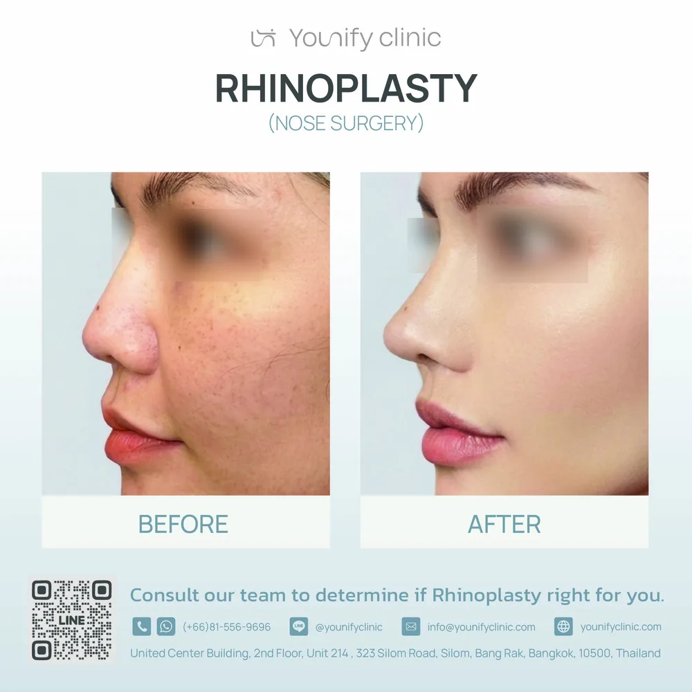 Rhinoplasty before & after result — YOUNIFY Clinic