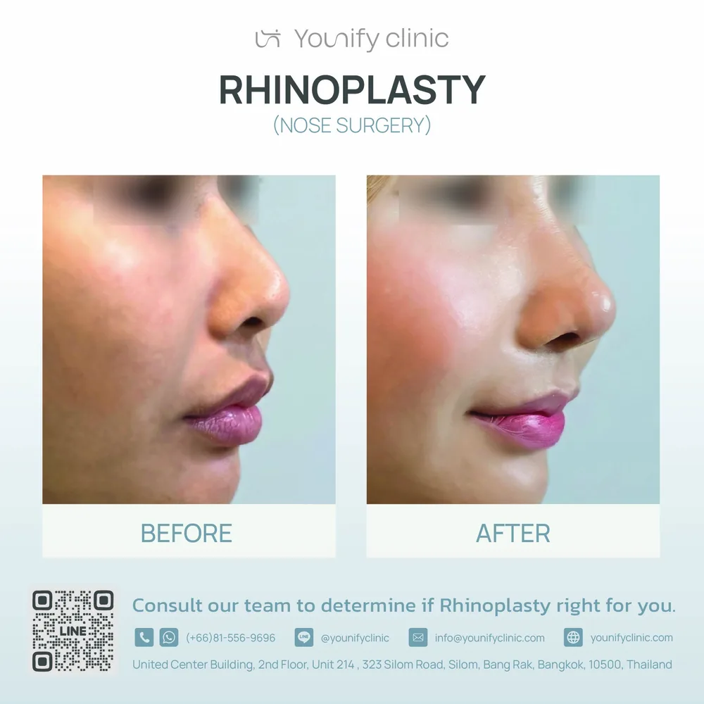 Rhinoplasty before & after result — YOUNIFY Clinic