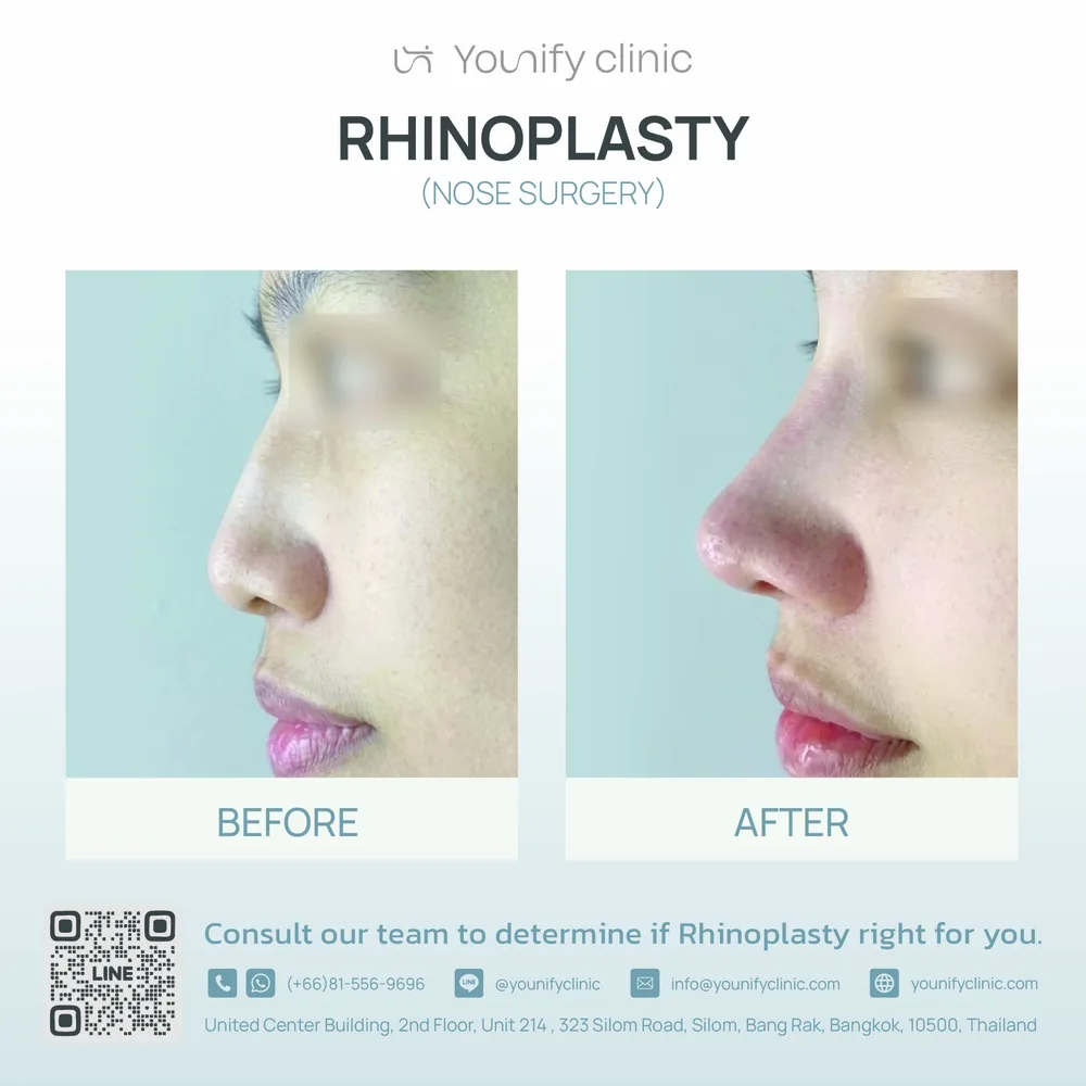 Rhinoplasty before & after result — YOUNIFY Clinic