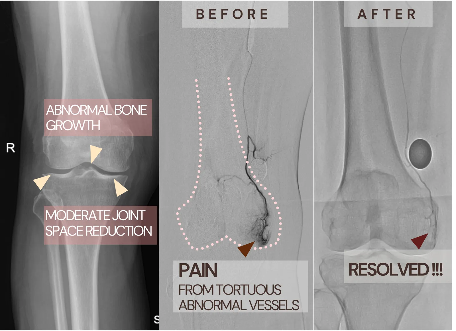 GAE before and after imaging comparison